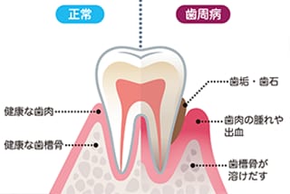 歯周病とは