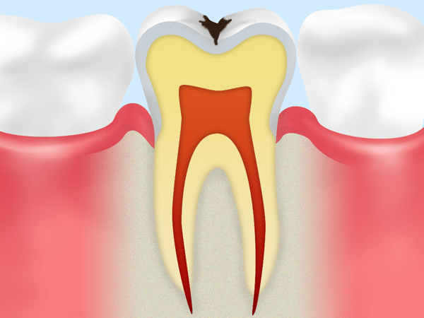 エナメル質の虫歯