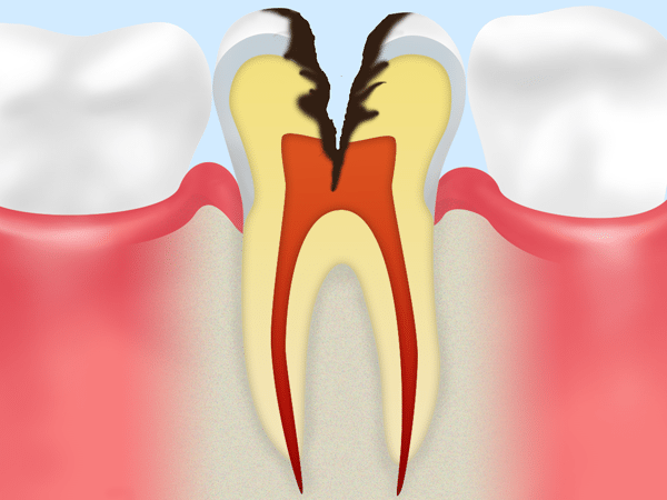神経まで達した虫歯