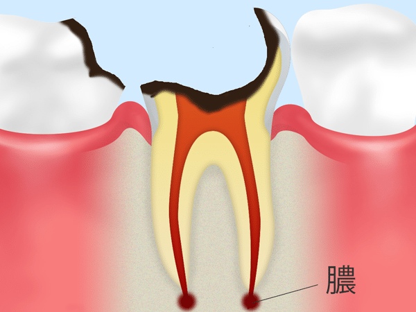歯の根まで達した