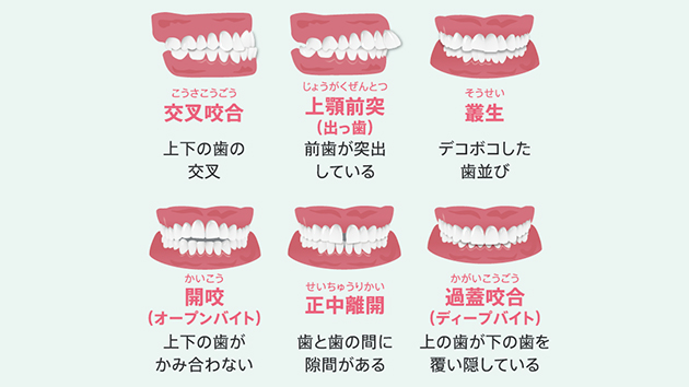 マウスピース矯正（アライナー矯正）の治療が受けられる症状について